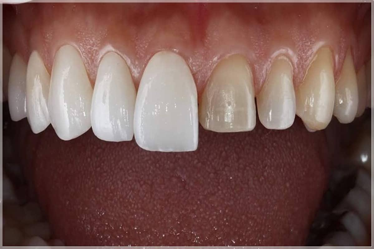 Zirkonyum ve Seramik Kaplamalar